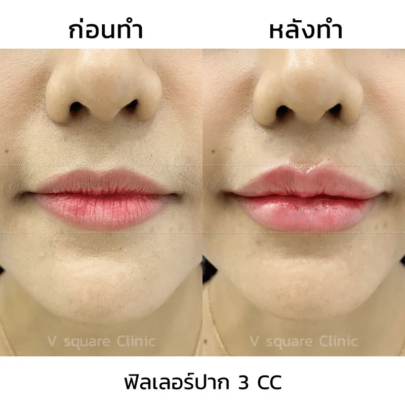 รีวิวฟิลเลอร์ปาก