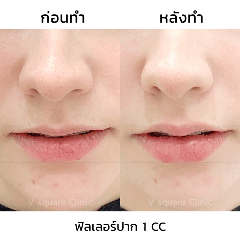 รีวิวฟิลเลอร์ปาก