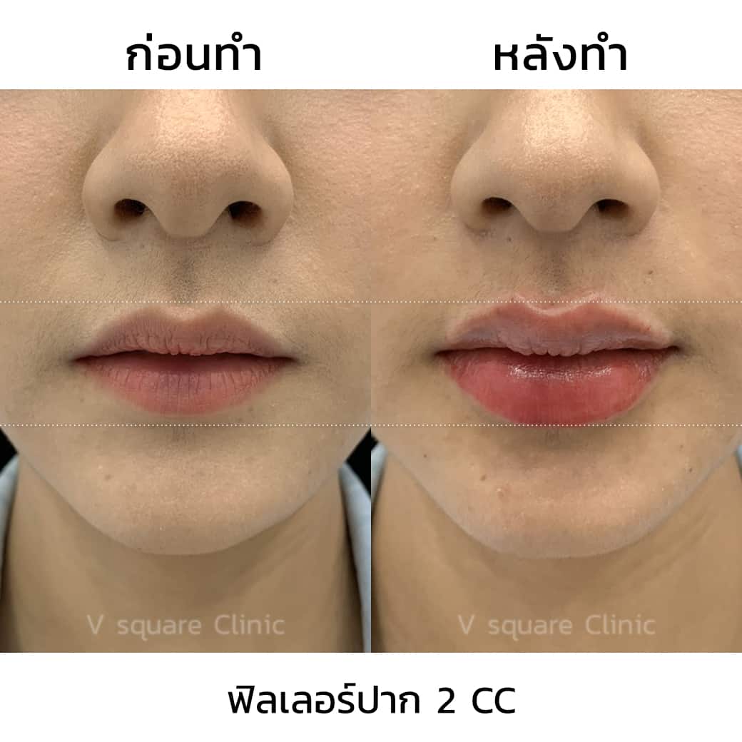 รีวิวฉีดฟิลเลอร์ปาก 2 CC