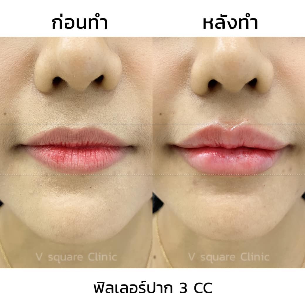 รีวิวฉีดฟิลเลอร์ปาก 3 CC