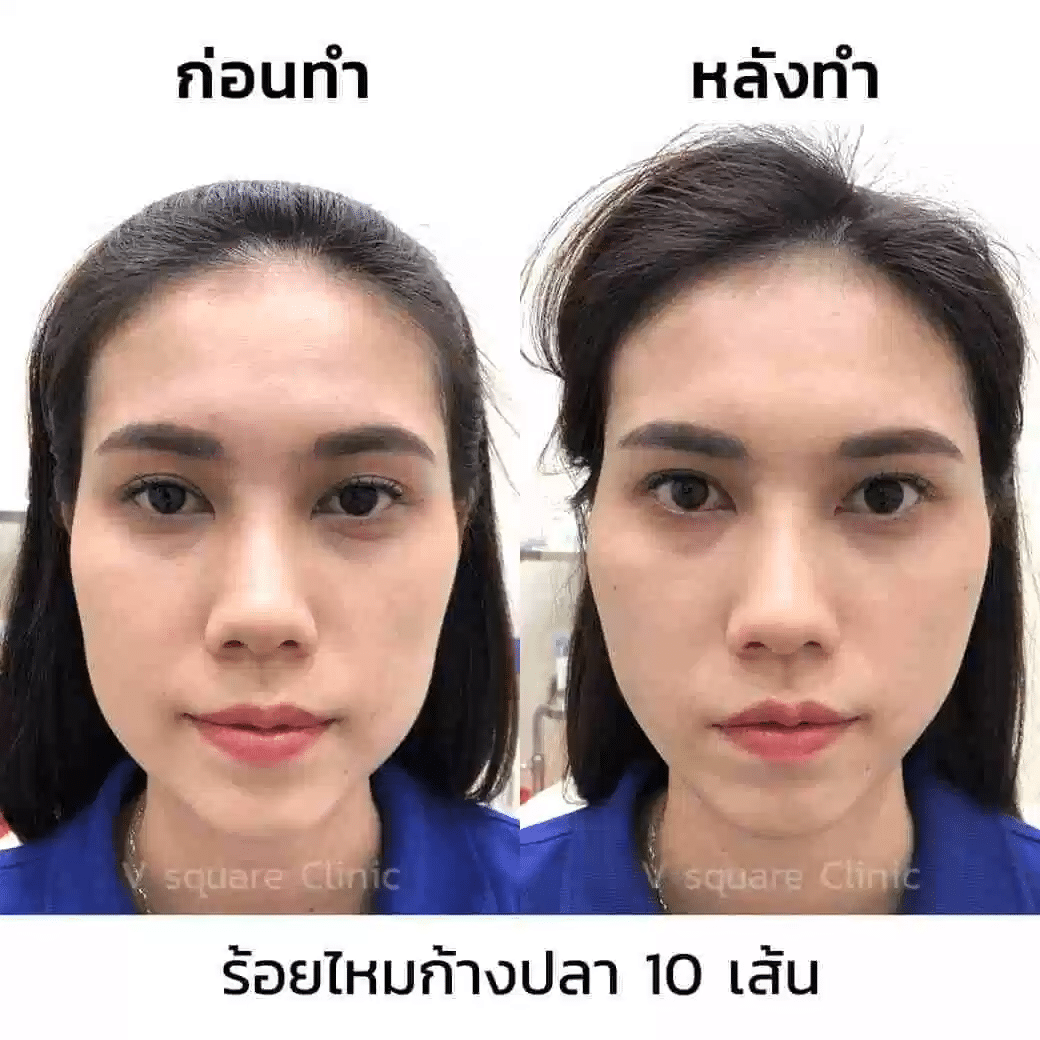 รีวิวหลังร้อยไหมก้างปลา 10 เส้น