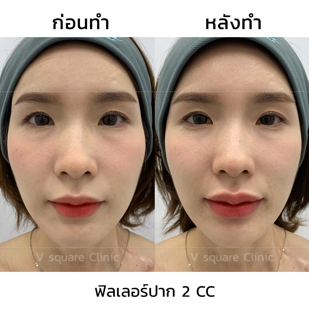 ฉีดฟิลเลอร์ปาก 2 cc รีวิว