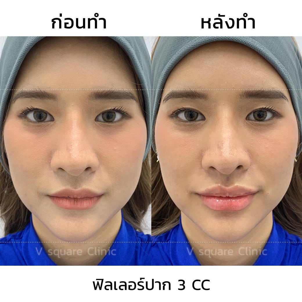 ฟิลเลอร์ปาก 3 cc