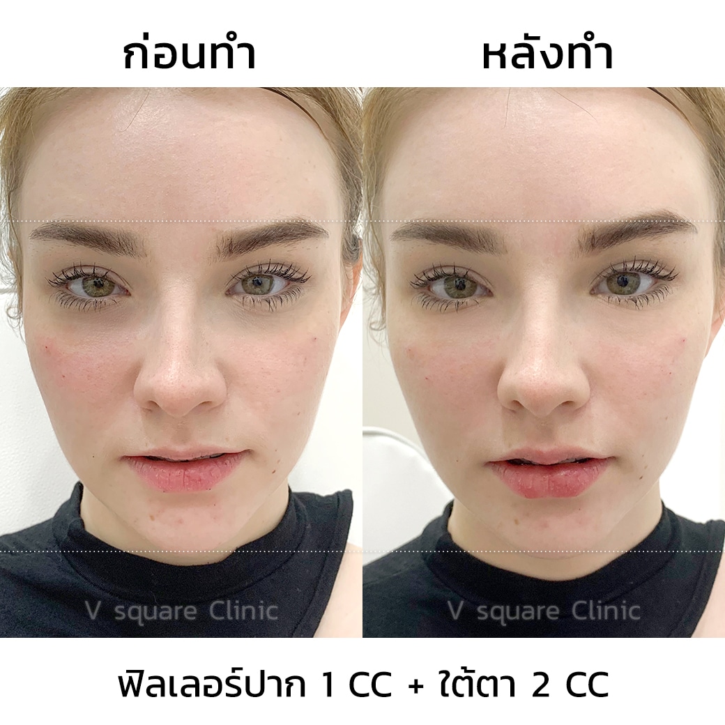 รีวิวฉีดฟิลเลอร์ปาก 1 CC