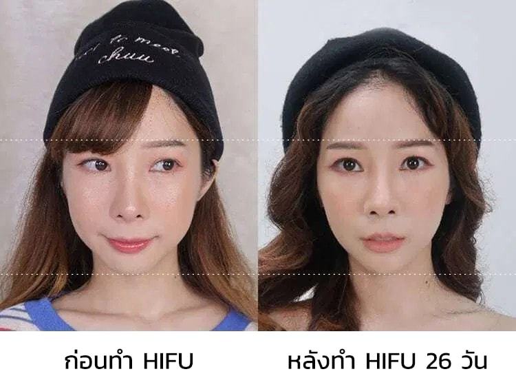 Hifu รีวิว 2023 ] Ultraformeriii ลดแก้ม เหนียง เพียง 28 วันใบหน้ากระชับ!