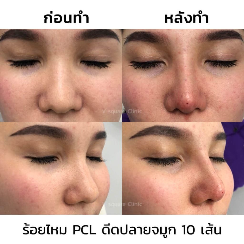 จมูกบาน ร้อยไหมเก็บปีกจมูก ลดขนาดรูจมูกดีไหม? อยู่ได้นานแค่ไหน ราคาเท่าไร?