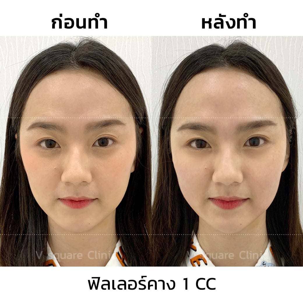 รีวิวโบท็อกหน้าผาก อายุน้อยแต่มีริ้วรอยเพราะผิวแห้งมาก  ดูแก่กว่าวัยทำยังไงดี?