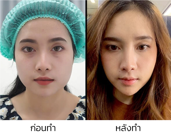 รวมวิธีปรับรูปหน้าให้เรียวสวย V-Shape เฉพาะบุคคล วิธีไหนดี เหมาะสมปลอดภัย