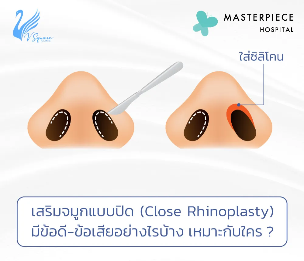 เสริมจมูกแบบปิด มีข้อดี-ข้อเสียอย่างไร ทำจมูกทรงไหนได้บ้าง?