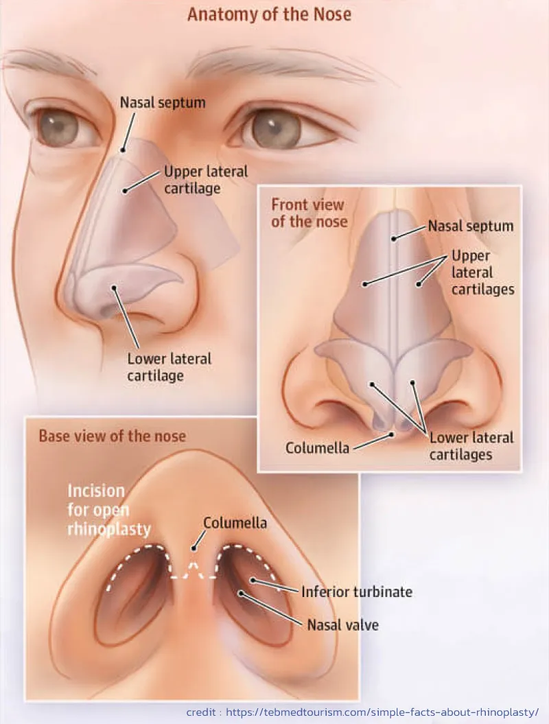 เสริมจมูกแบบโอเพ่นคืออะไร ดีอย่างไร เหมาะกับใครบ้าง แพงไหม หมอที่ไหนดี?