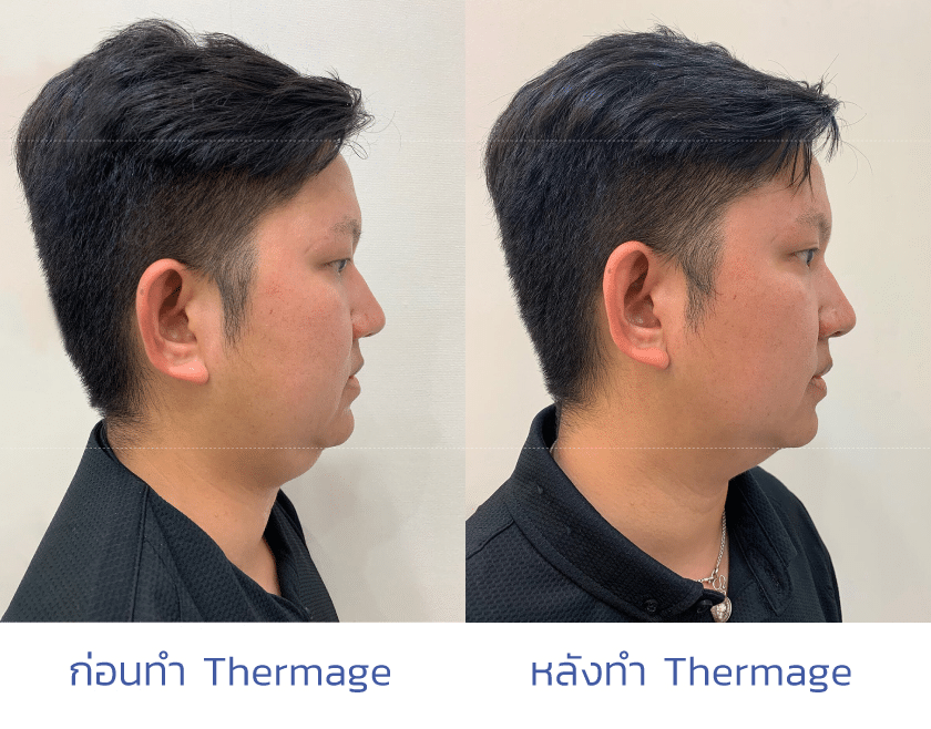 รีวิว Thermage