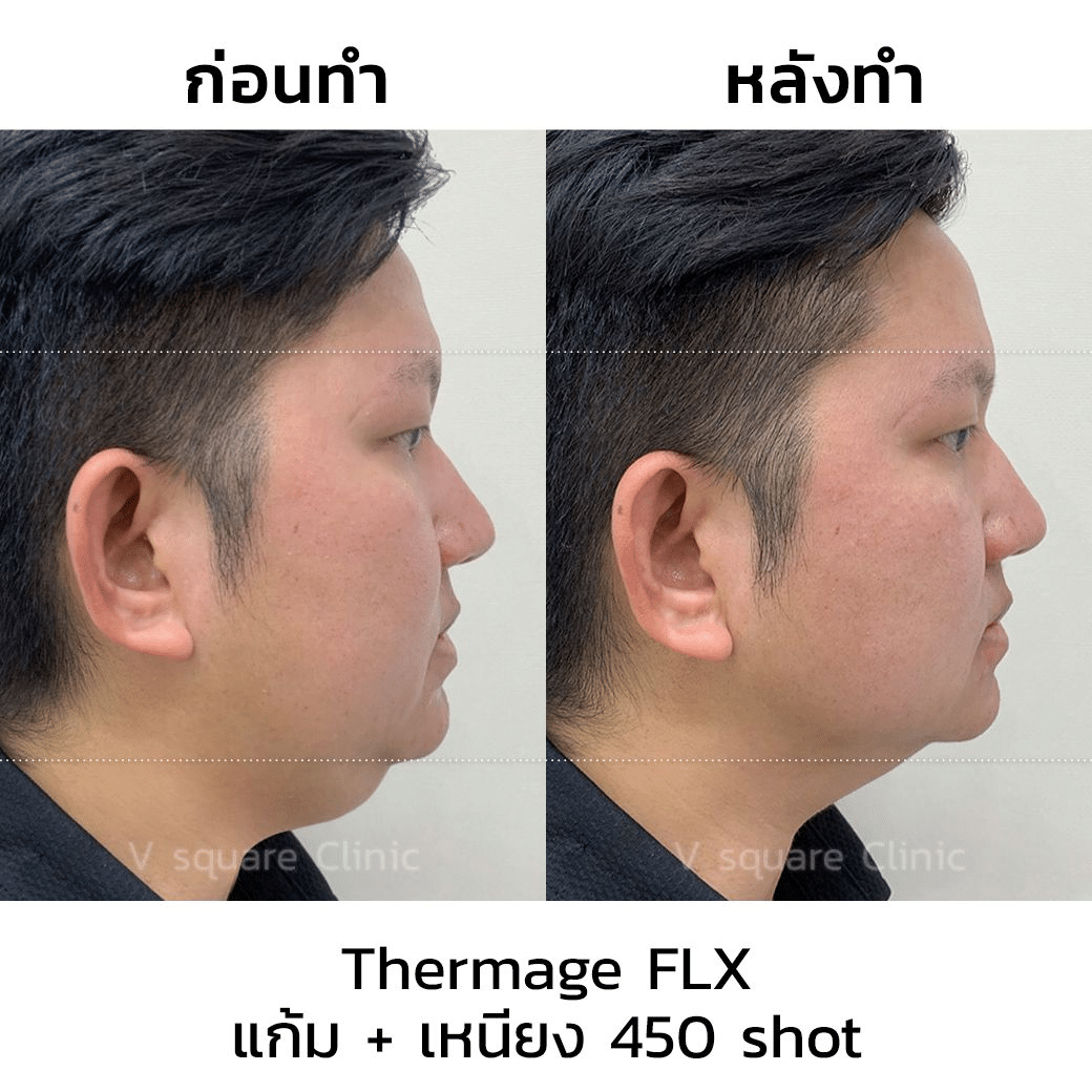 รีวิว Thermage