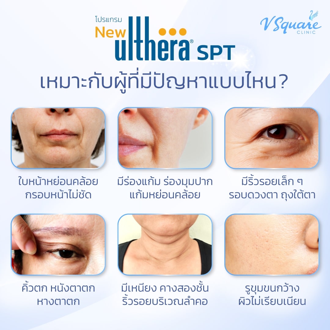 Ulthera SPT เหมาะกับใคร