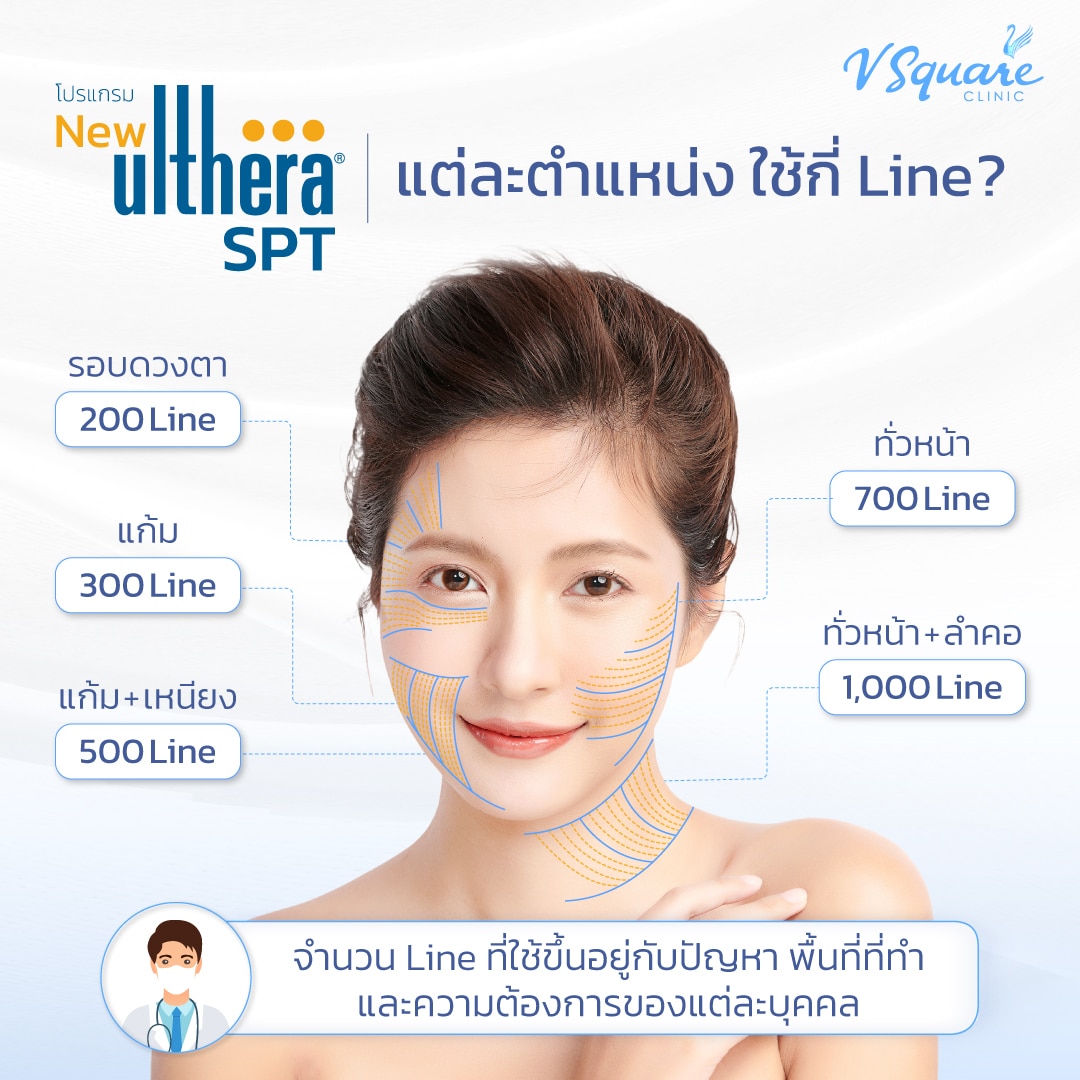 Ulthera SPT แต่ละตำแหน่งใช้กี่ช็อต