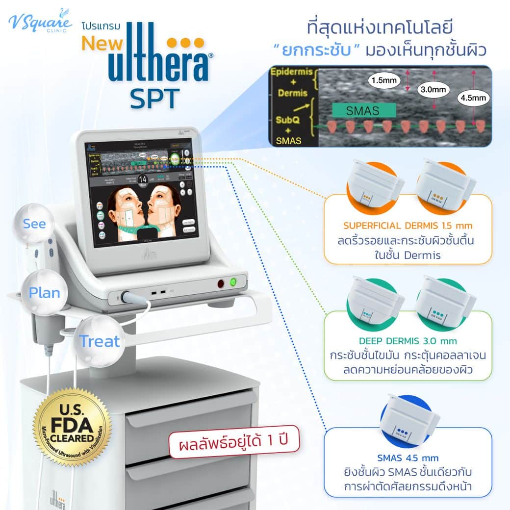 การทำงาน Ulthera SPT