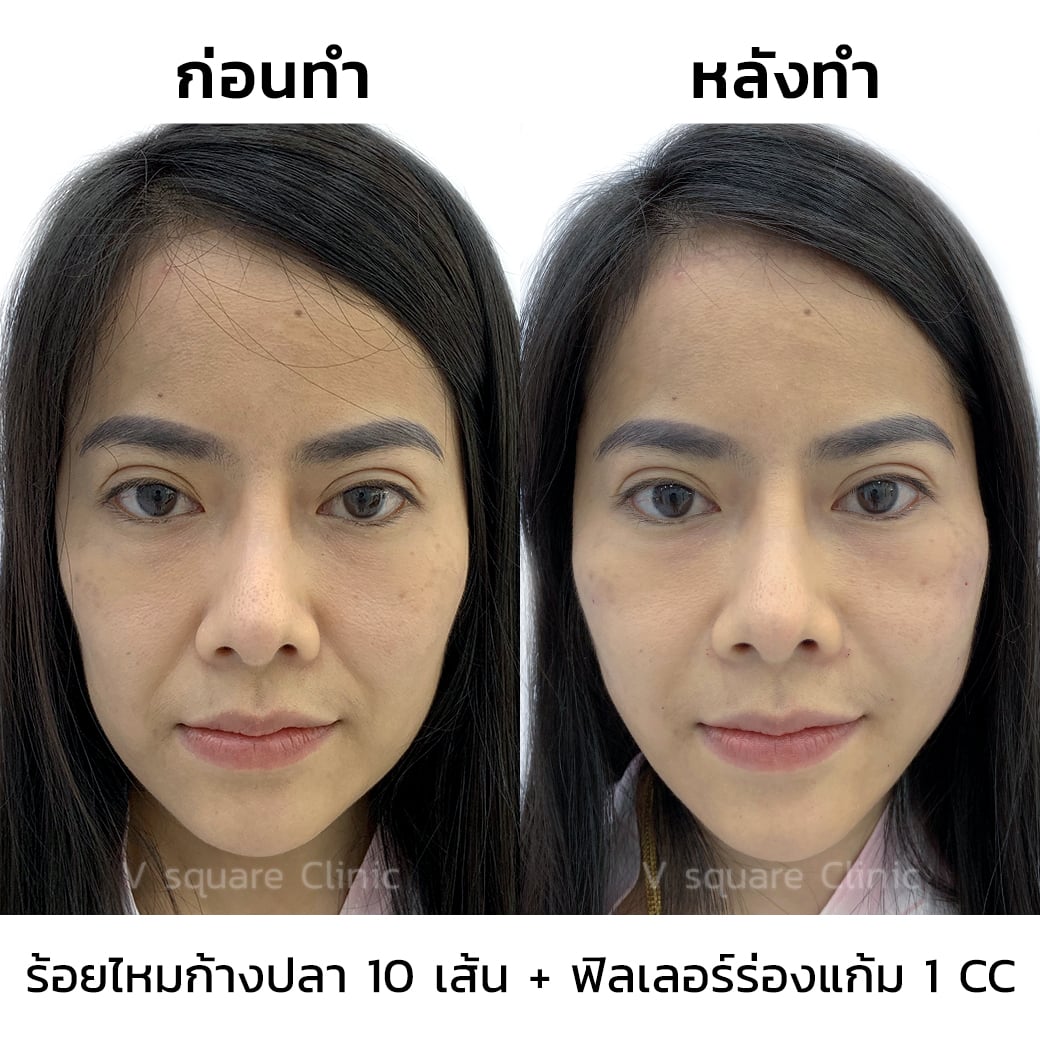 รีวิว ร้อยไหมก้างปลา-ฟิลเลอร์