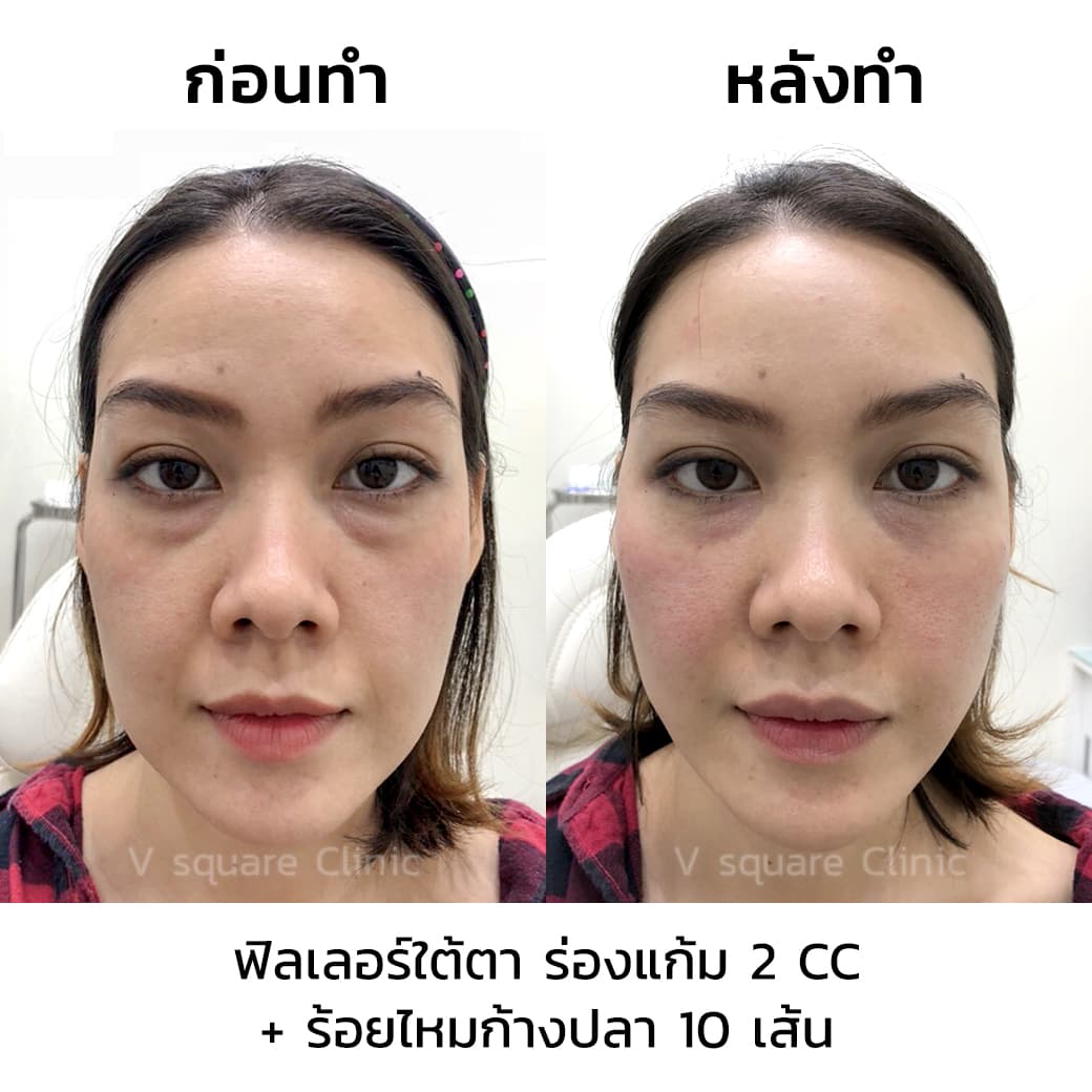 รีวิว ร้อยไหมก้างปลา-ฟิลเลอร์ร่องแก้ม