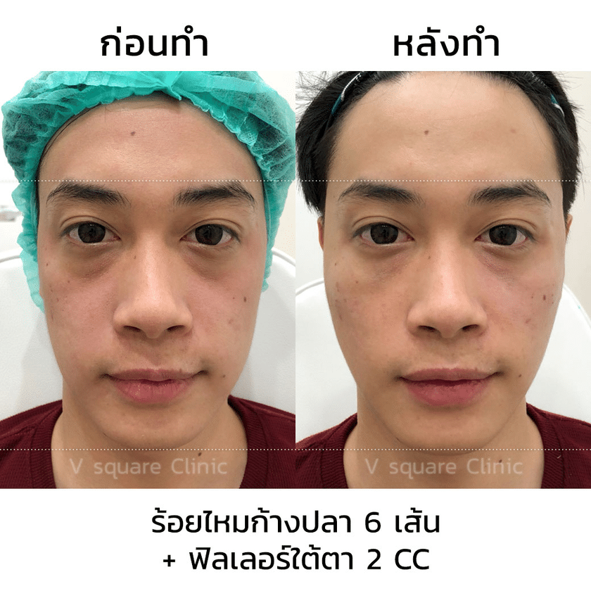 รีวิวร้อยไหมก้างปลา