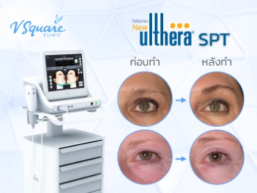 Ulthera รอบดวงตา 370x277