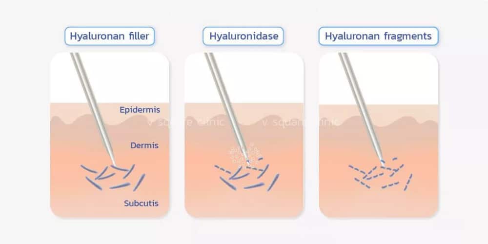 การทำงานของ Hyaluronidase