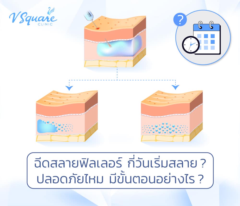 ฉีดสลายฟิลเลอร์