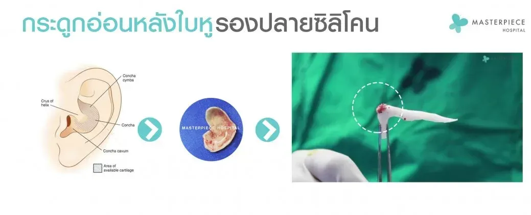 เสริมจมูกกระดูกอ่อนหลังหู คืออะไร? ต่างจากวิธีอื่นอย่างไร? รู้ข้อดี-ข้อเสีย