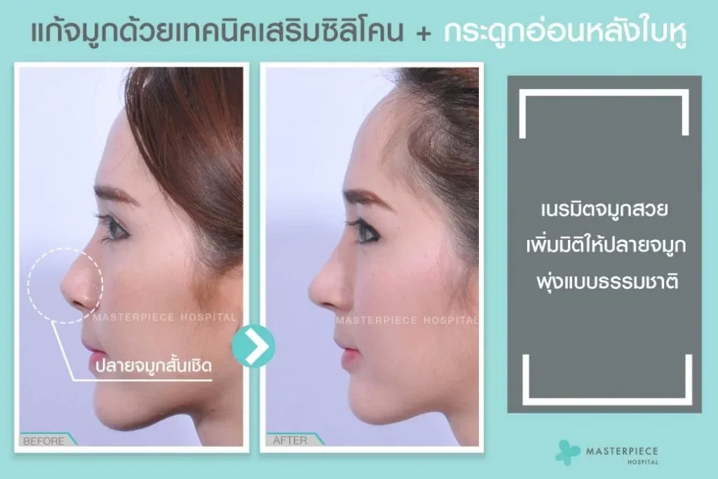 เสริมจมูกกระดูกอ่อนหลังหู คืออะไร? ต่างจากวิธีอื่นอย่างไร? รู้ข้อดี-ข้อเสีย