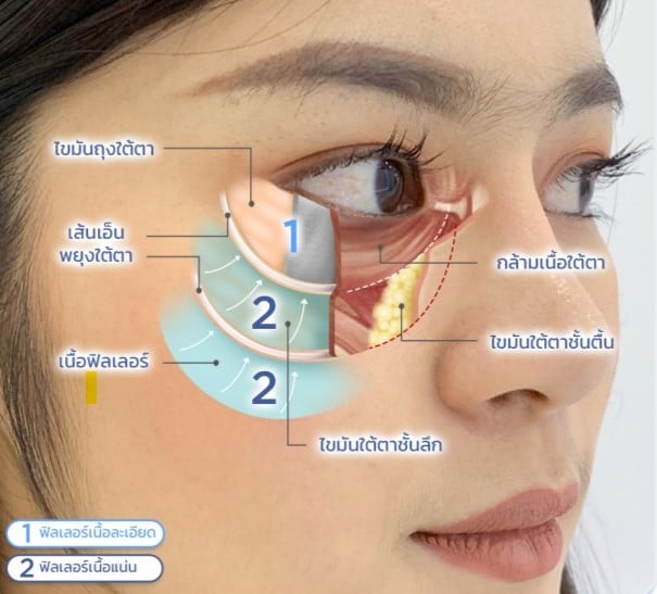 ฉีดฟิลเลอร์ใต้ตา