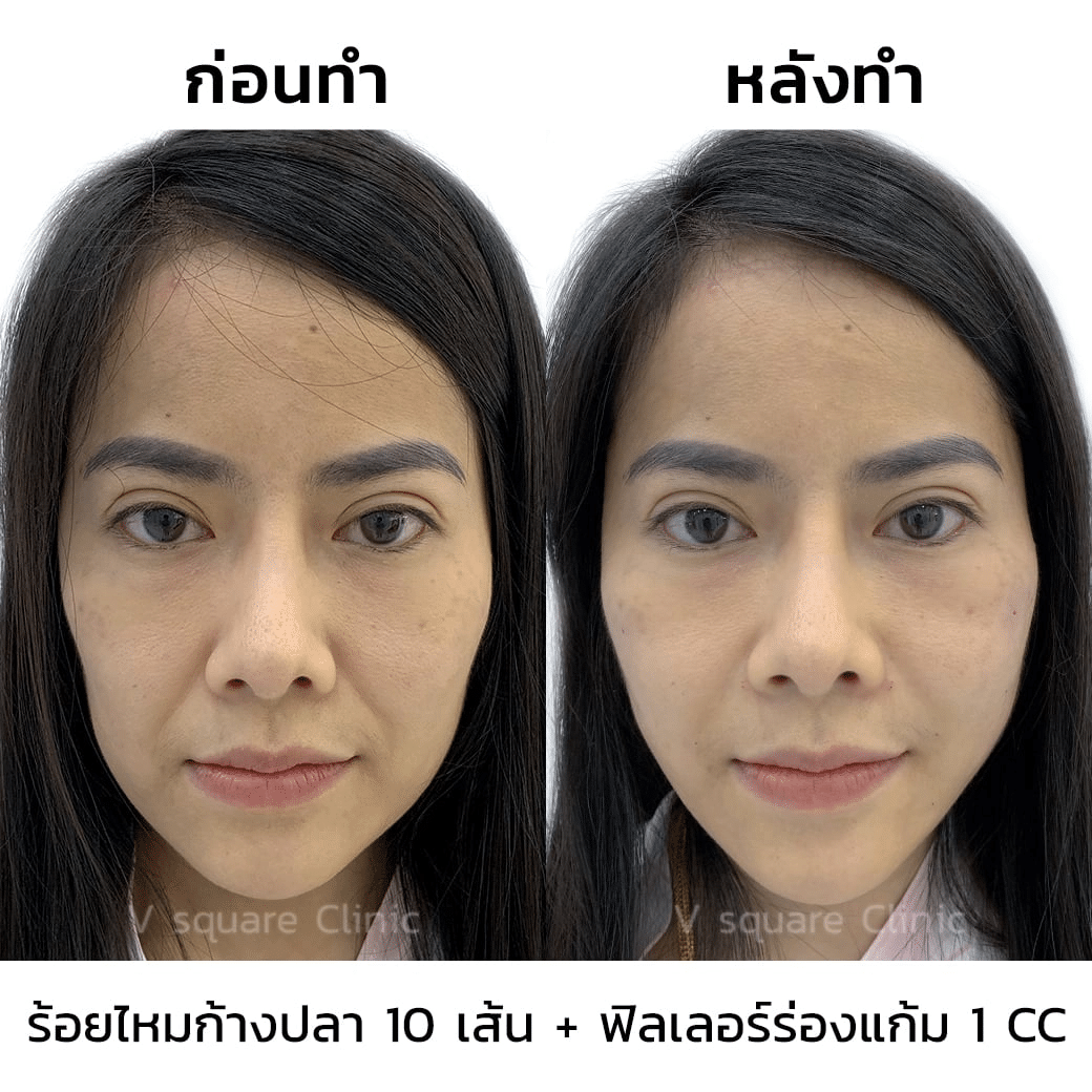 รีวิว ร้อยไหมละลาย ยกกระชับ