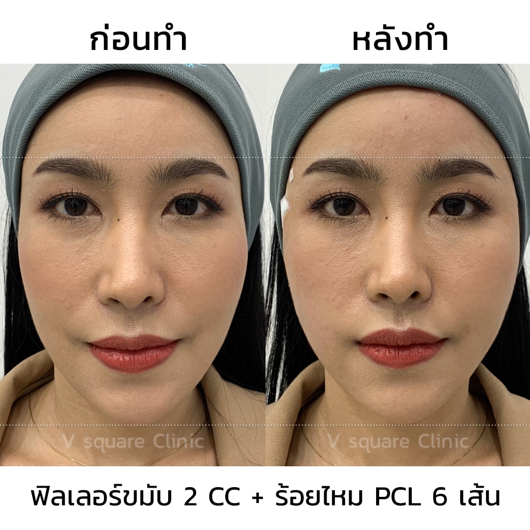 รีวิว ร้อยไหมละลาย ยกกระชับ