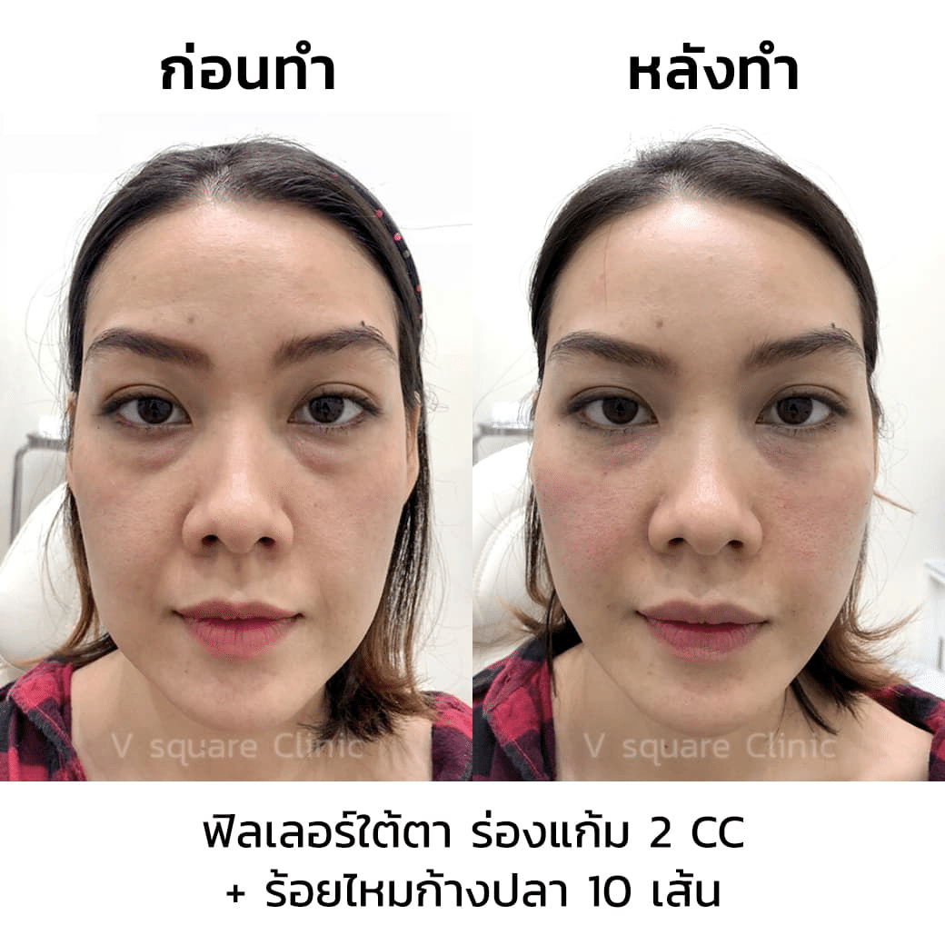 รีวิว ร้อยไหมละลาย ยกกระชับ