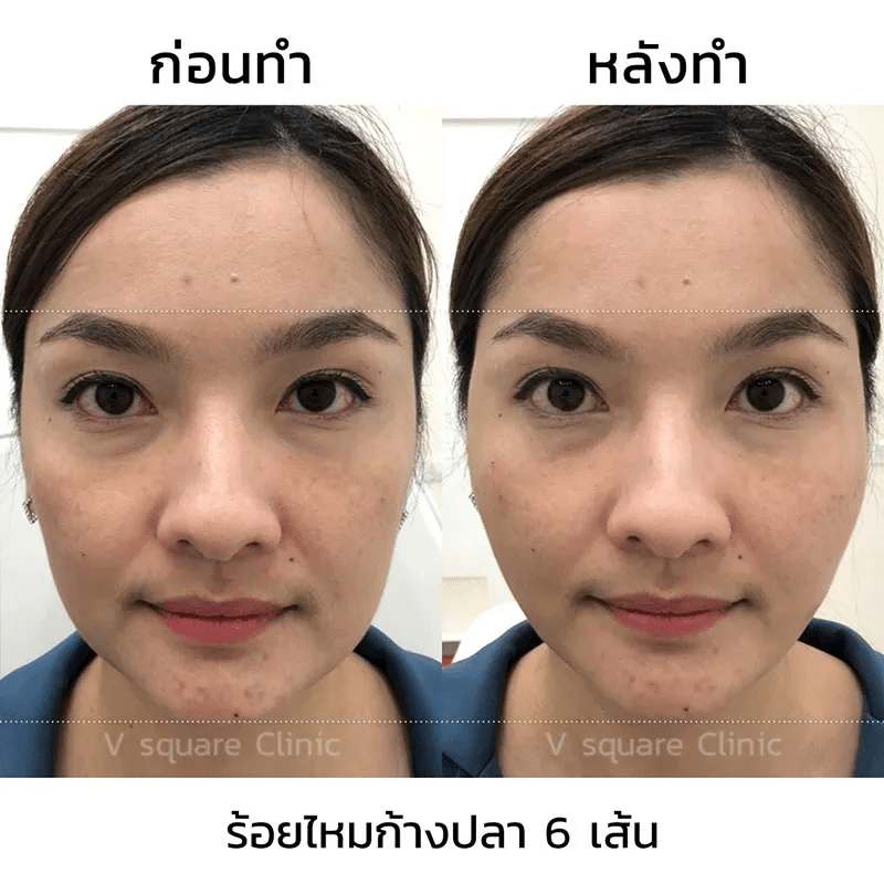 รีวิว ร้อยไหมละลาย ยกกระชับ