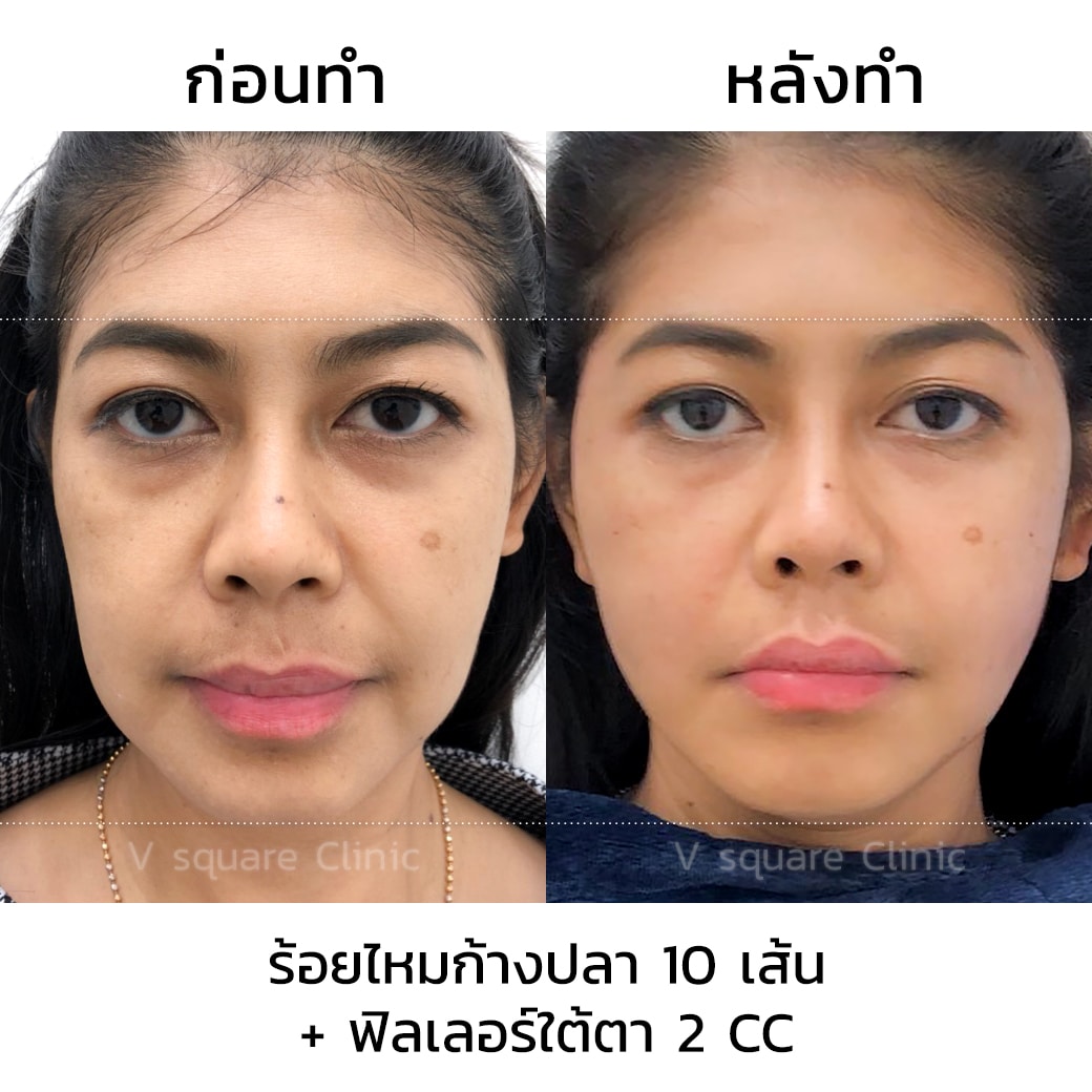 รีวิว ร้อยไหมละลาย ยกกระชับ