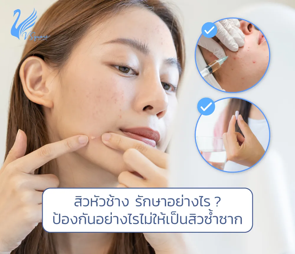 สิวหัวช้าง เกิดจากสาเหตุใด อันตรายไหม มีวิธีป้องกันไม่ให้เป็นสิวซ้ำซาก