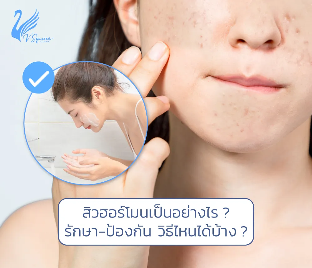 เจาะลึกสาเหตุสิวฮอร์โมน และแนวทางป้องกันรักษาอย่างถูกวิธี