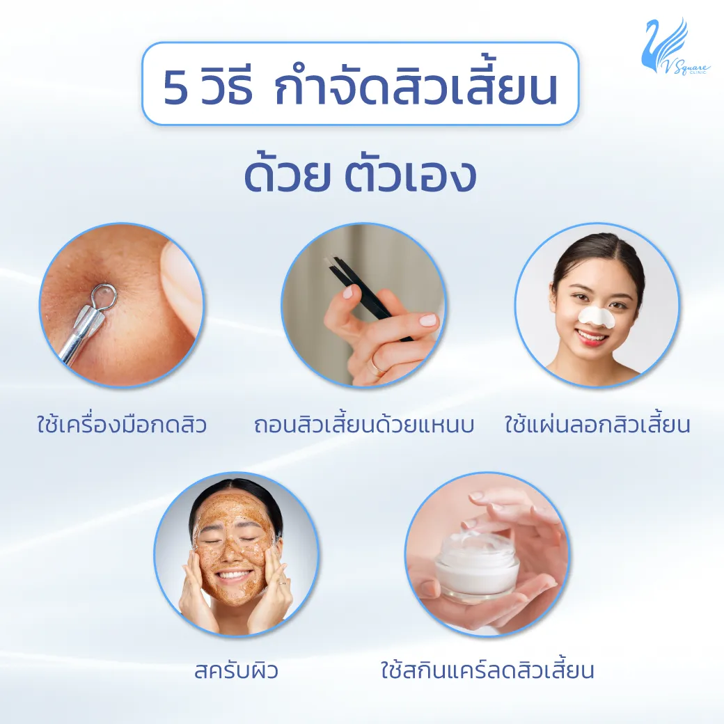 วิธีกำจัดสิวเสี้ยนอย่างเห็นผล มีสาเหตุและป้องกันอย่างไรบ้าง ?