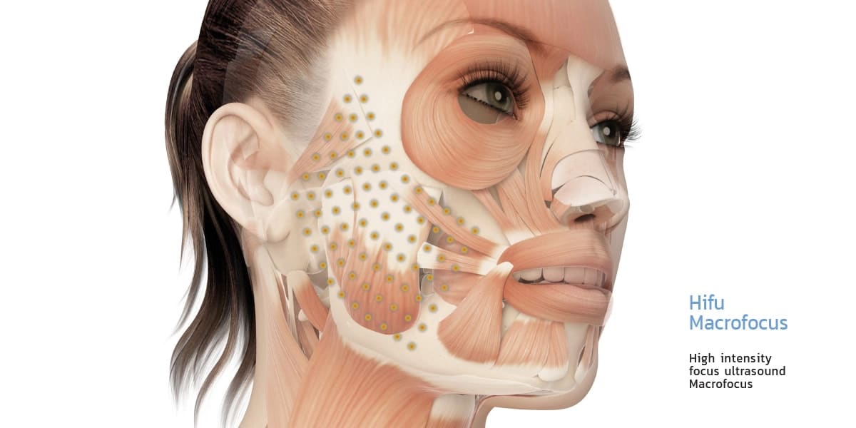 พลังงาน High intensity focus ultrasound Macrofocus