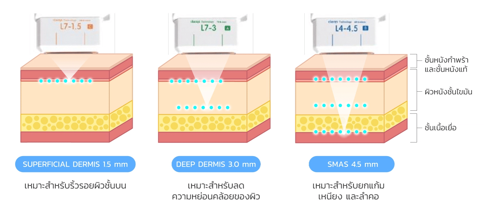 หัว Ultraformer III