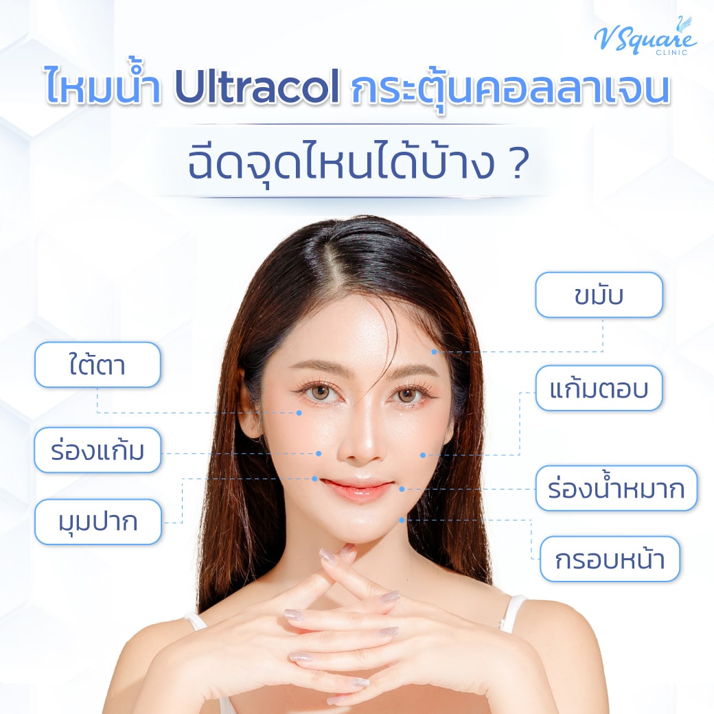 ตำแหน่งฉีด Ultracol