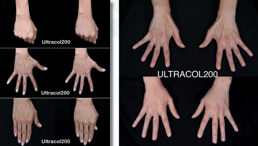 รีวิว Ultracol