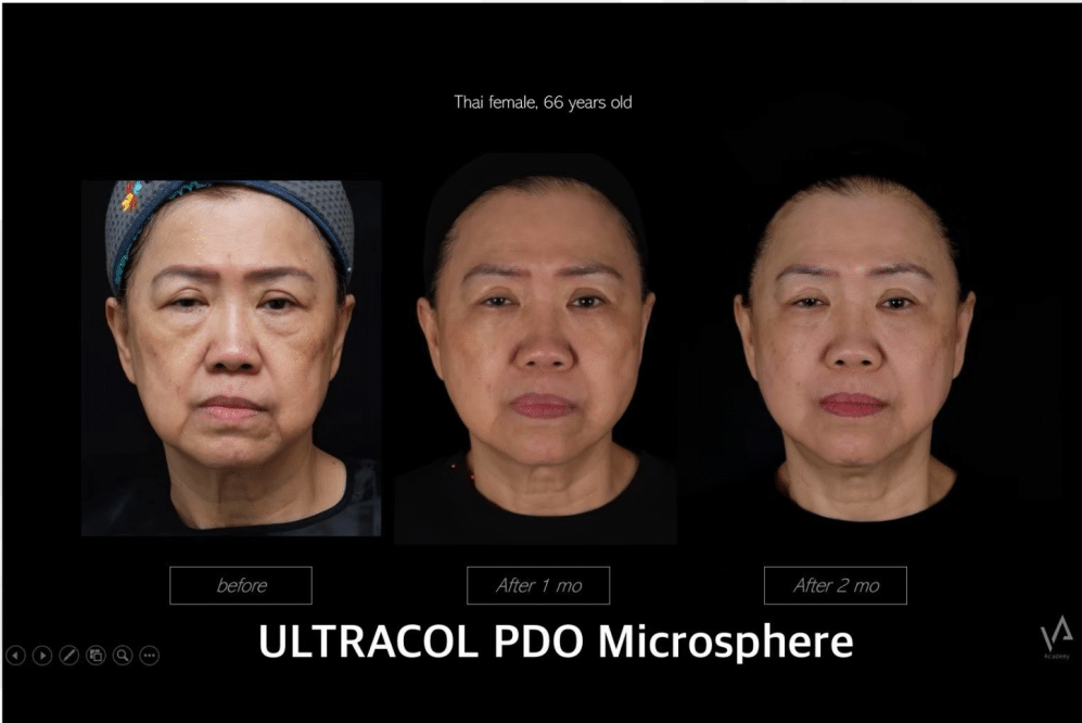 รีวิว Ultracol(3)