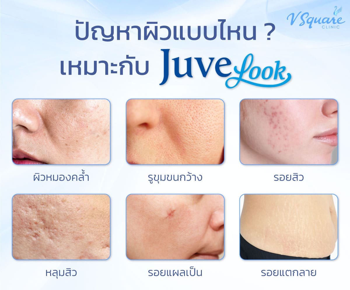 ใครเหมาะกับการใช้ Juvelook