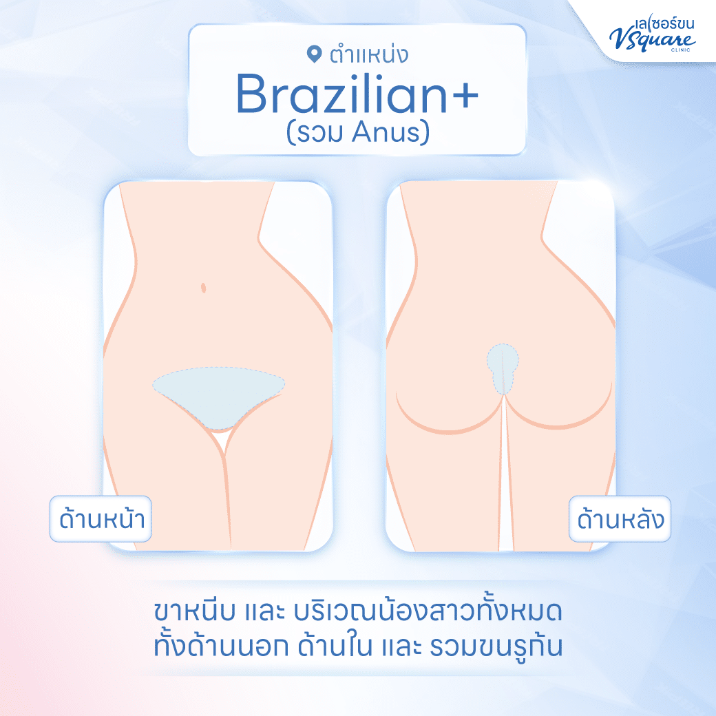 เลเซอร์บิกินี่ มีกี่แบบ