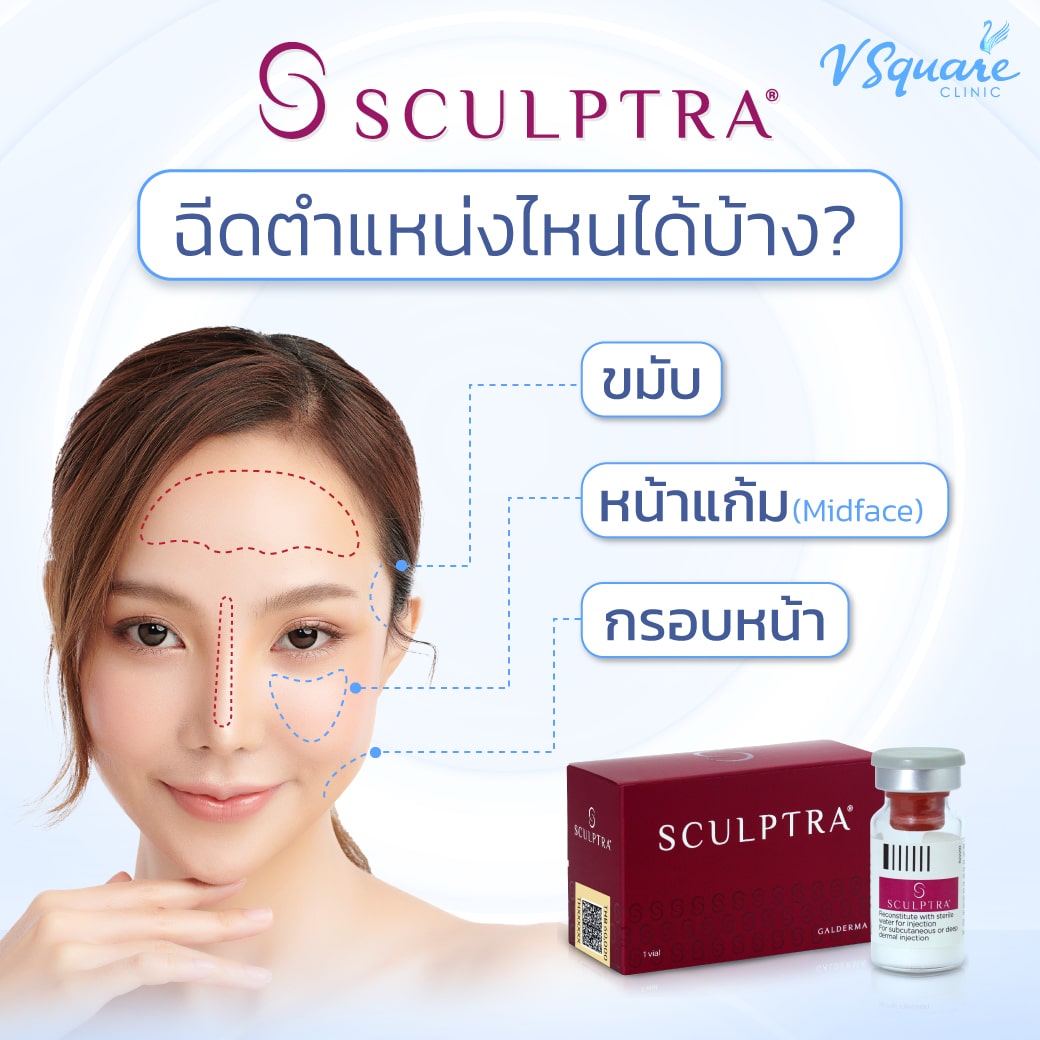 Sculptra ฉีดตำแหน่งไหน