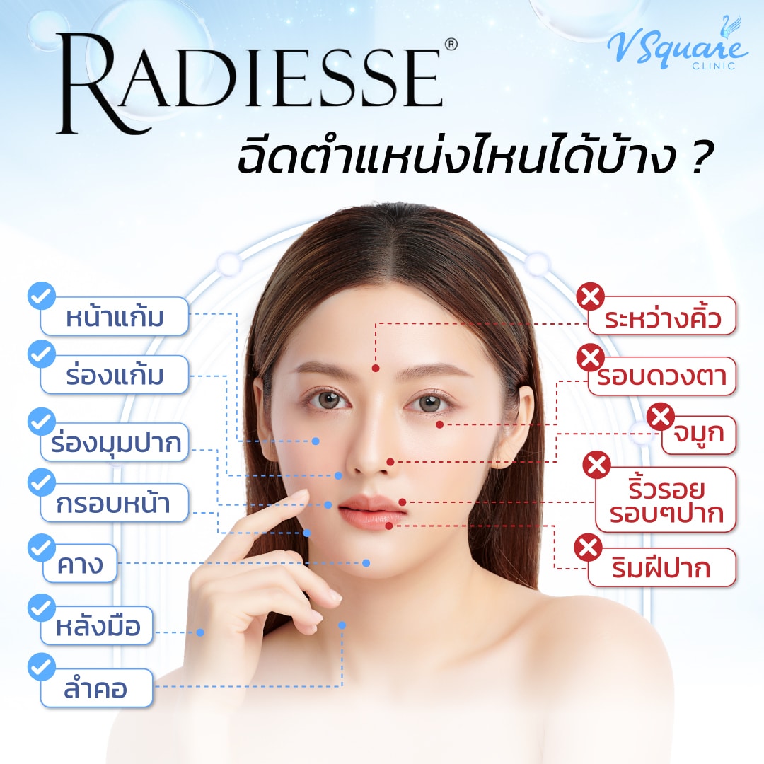 Radiesse ฉีดตำแหน่งไหน