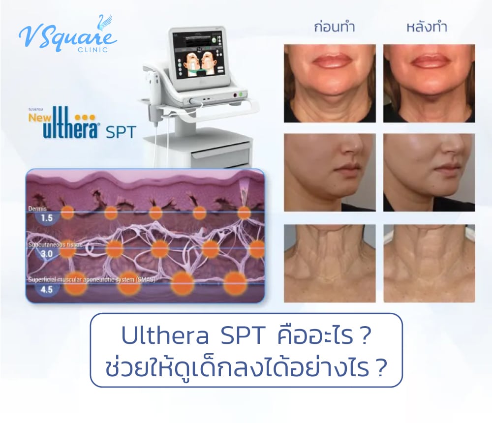 Ulthera-SPTคืออะไร