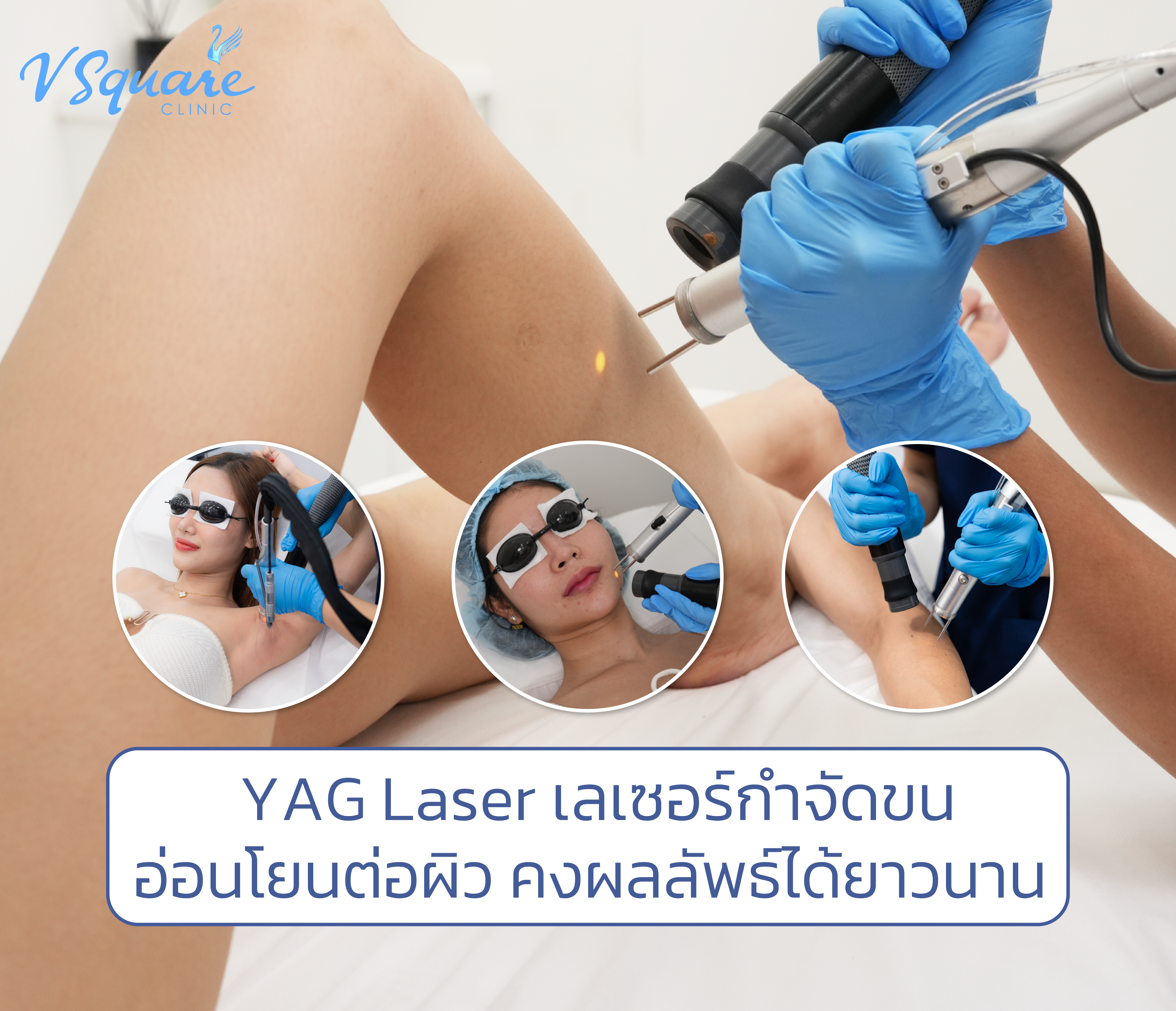 YAG Laser