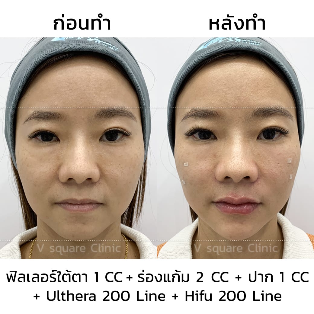 รีวิว ulthera และ hifu