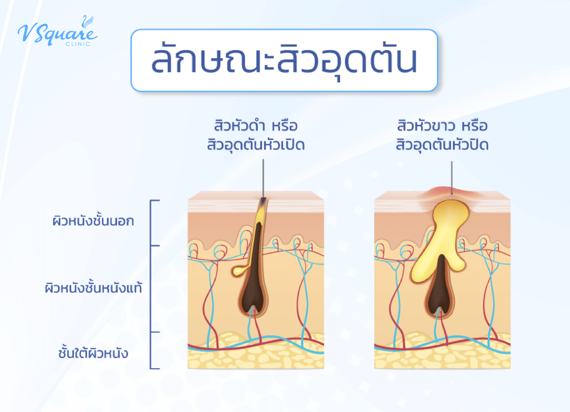 ลักษณะสิวอุดตัน