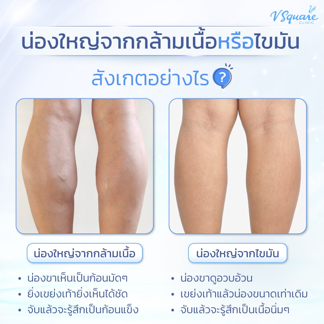 วิธีสังเกตน่องใหญ่เกิดจากอะไร